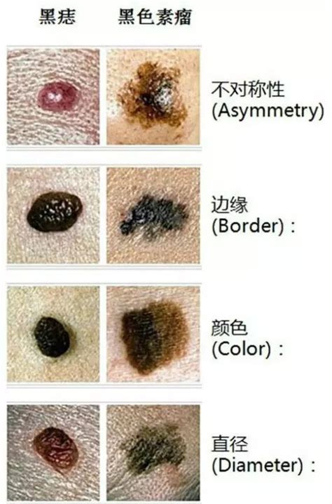 頭上有肉痣|是痣還是瘤？黑色素瘤的類型、症狀與治療